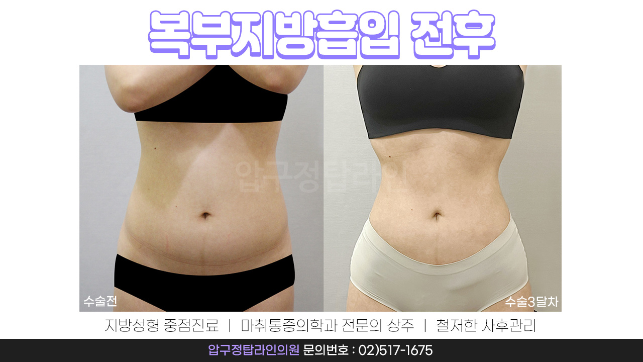 지방흡입은 역시 압구정탑라인의원