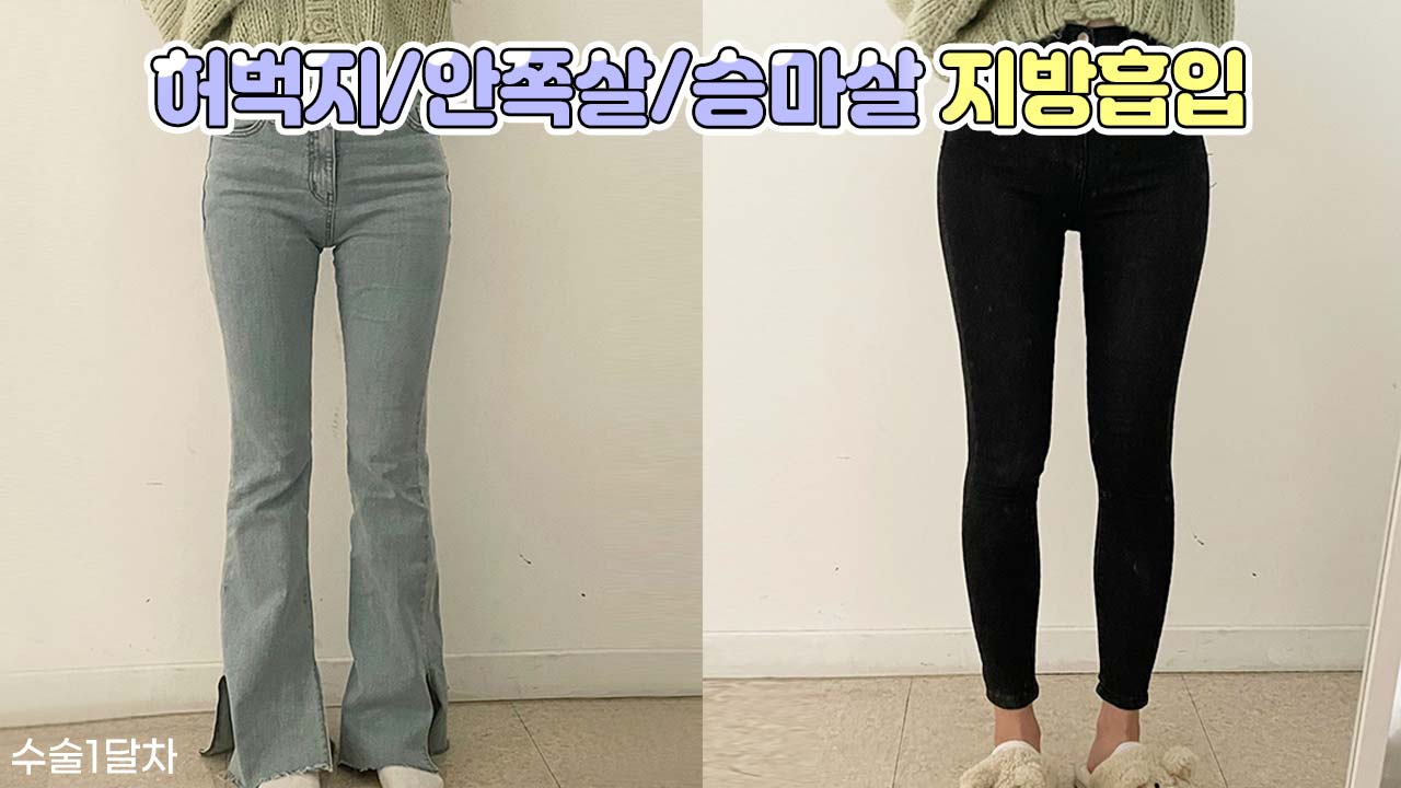 지방흡입은 역시 압구정탑라인의원