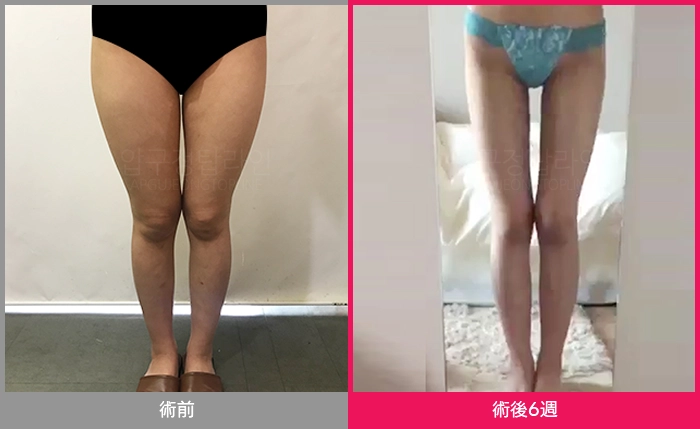 狎鴎亭TOPLINEの脂肪吸引ビフォーアフター症例写真 1