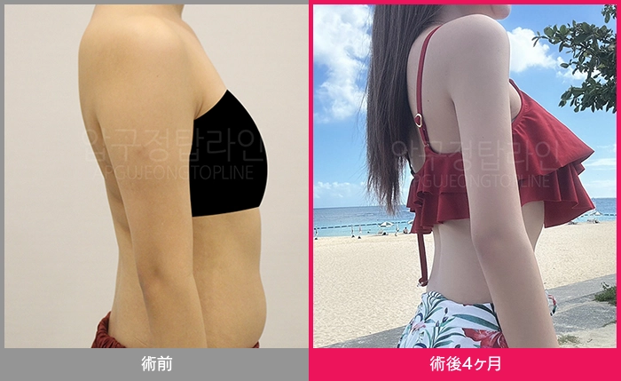 狎鴎亭TOPLINEの脂肪吸引ビフォーアフター症例写真 2