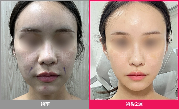 狎鴎亭TOPLINEの脂肪吸引ビフォーアフター症例写真 4